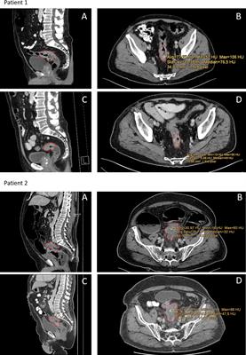 Computertomography-Based Prediction of Complete Response Following Neoadjuvant Chemoradiotherapy of Locally Advanced Rectal Cancer